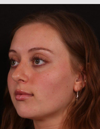 After Image: Buccal Fat Removal - left-front-oblique