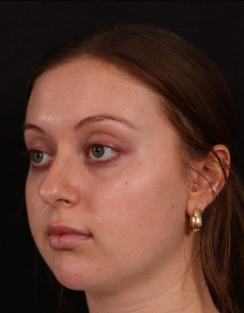 Before Image: Buccal Fat Removal - left-front-oblique