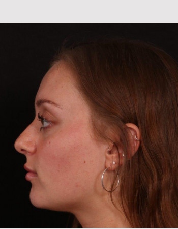 After Image: Buccal Fat Removal - left-side