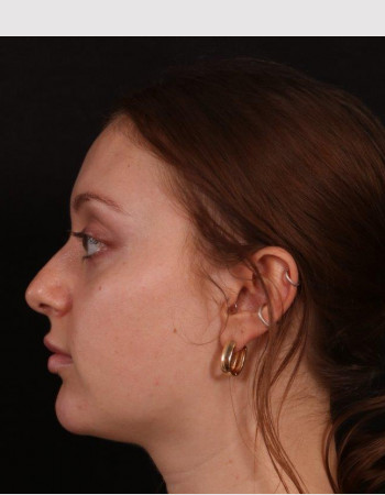 Before Image: Buccal Fat Removal - left-side