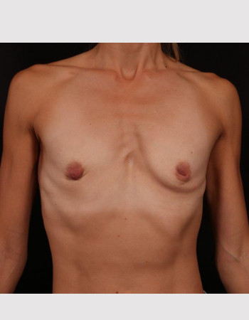 Before Image: Breast Augmentation - front
