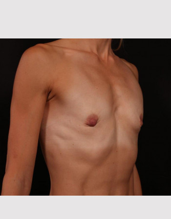 Before Image: Breast Augmentation - right-front-oblique