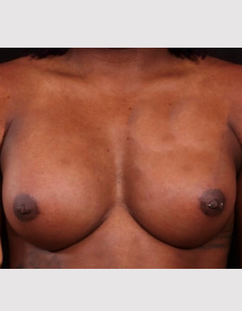 After Image: Breast Augmentation - front