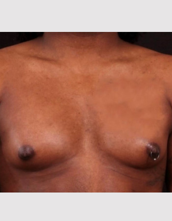 Before Image: Breast Augmentation - front