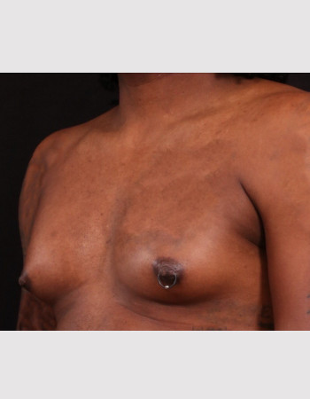 Before Image: Breast Augmentation - other