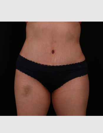 After Image: Tummy Tuck (Abdominoplasty) - front