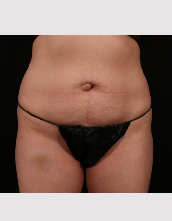 Before Image: Tummy Tuck (Abdominoplasty) - front