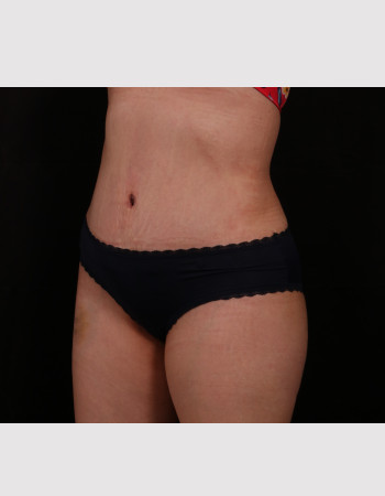 After Image: Tummy Tuck (Abdominoplasty) - other