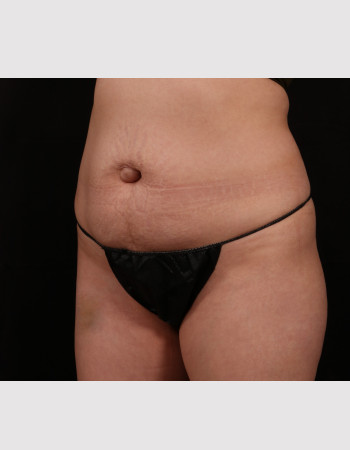 Before Image: Tummy Tuck (Abdominoplasty) - other