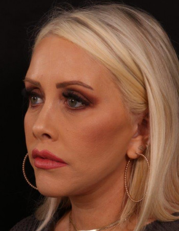 After Image: Lower Facelift - left-front-oblique
