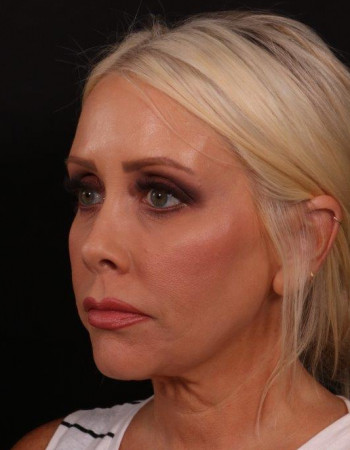 Before Image: Lower Facelift - left-front-oblique
