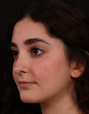 After Image: Rhinoplasty - left-front-oblique