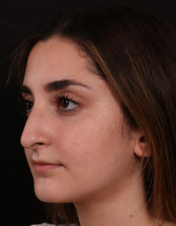 Before Image: Rhinoplasty - left-front-oblique
