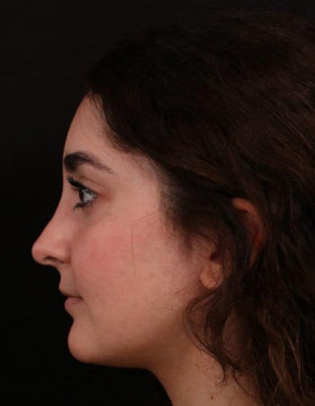 After Image: Rhinoplasty - left-side