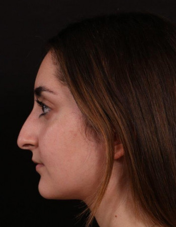Before Image: Rhinoplasty - left-side
