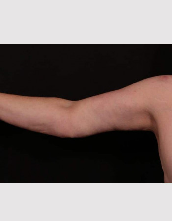 After Image: Brachioplasty - front