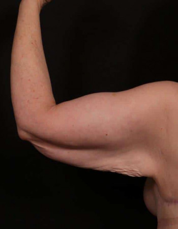 Before Image: Brachioplasty - front