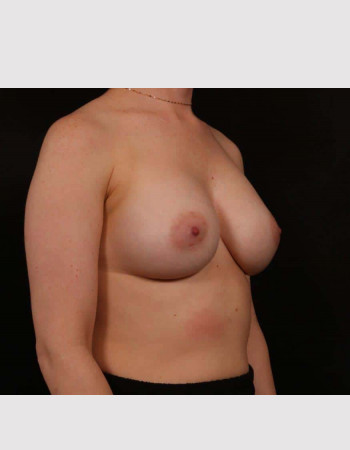 After Image: Breast Augmentation - right-front-oblique